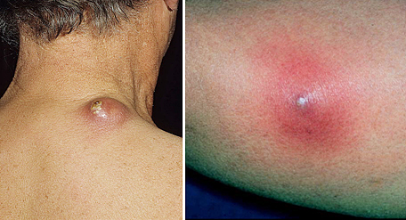 Лечение гнойно-воспалительных процессов кожи, подкожной клетчатки