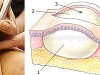 Удаление образований кожи и подкожной клетчатки
