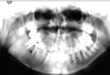 оссифицирующая фиброма верхней челюсти слева
